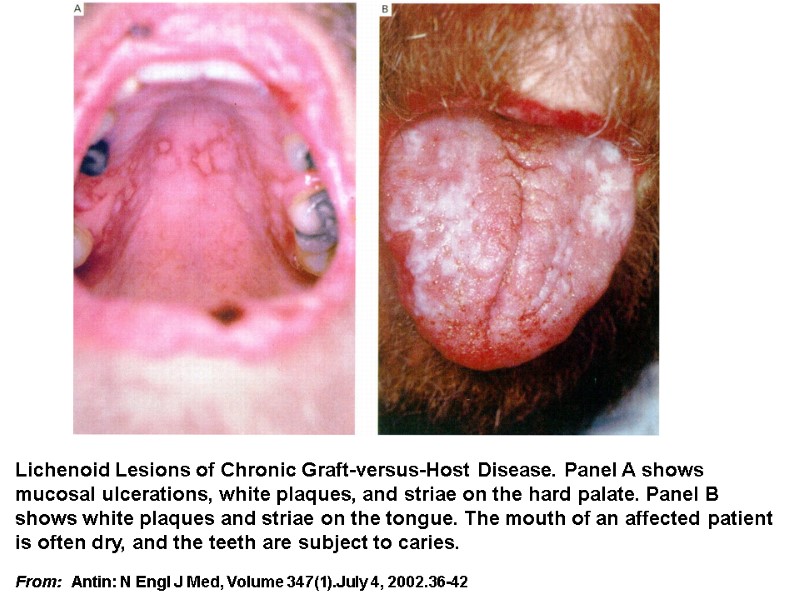 Lichenoid Lesions of Chronic Graft-versus-Host Disease. Panel A shows mucosal ulcerations, white plaques, and